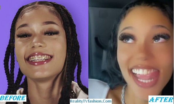 Updated Coi Leray Teeth Fixed Before And After 2023 3077