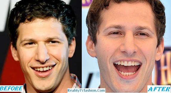 Andy Samberg Teeth Before After