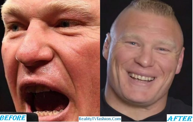 Brock Lesnar Teeth