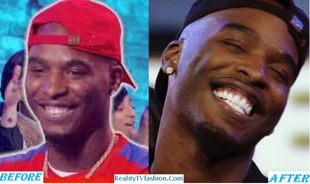 Hitman Holla Teeth Before After