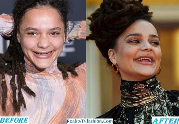 Sasha Lane Teeth Before After