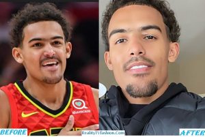 Trae Young Teeth Before After