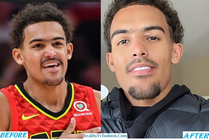 Trae Young Teeth Before & After