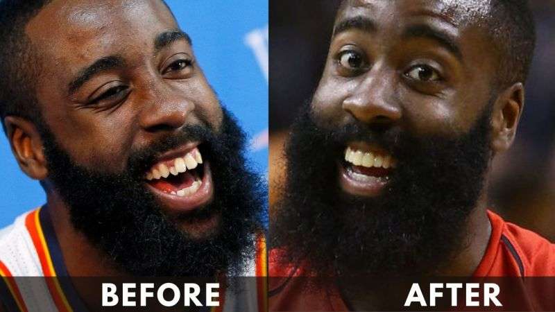 James Harden Teeth Before and After Transformation 2023