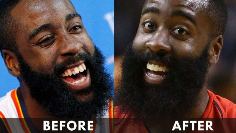 James Harden Teeth Before and After Transformation